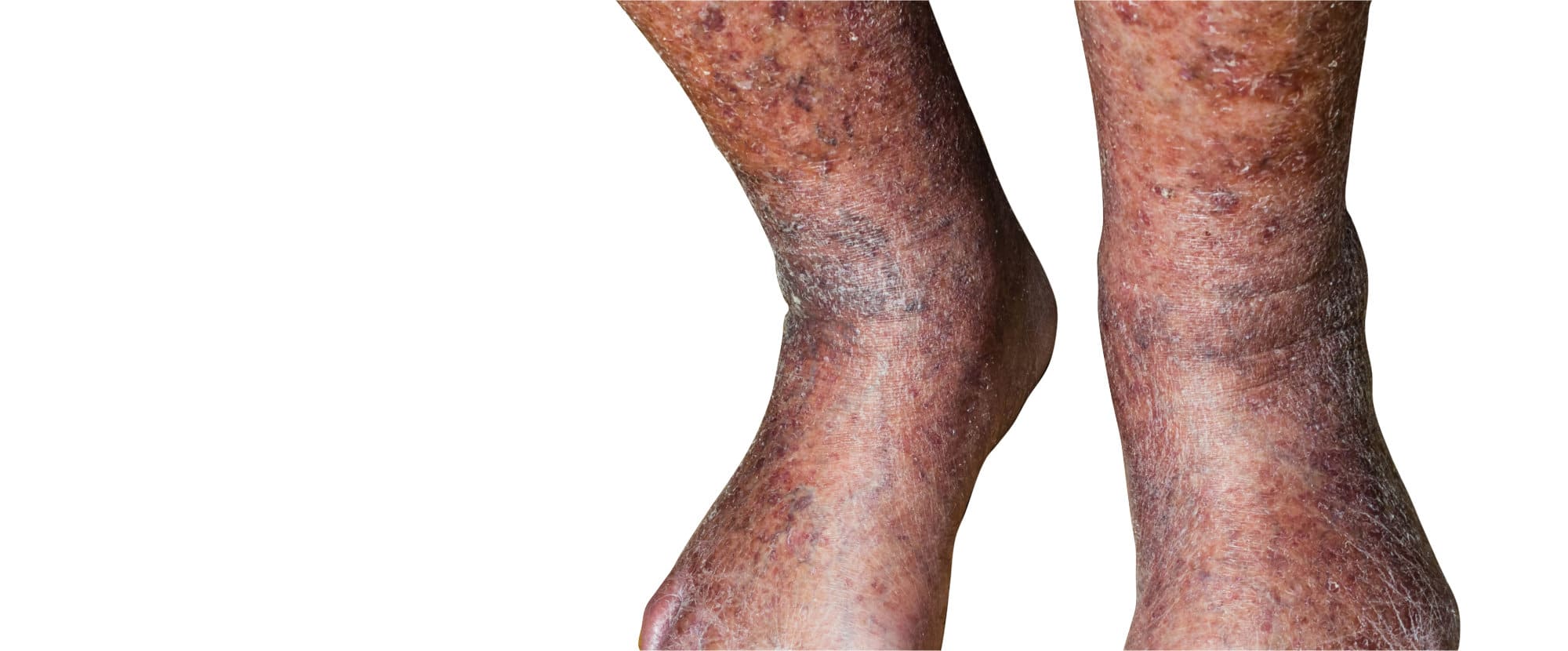 Diabetes skin rash itch on legs