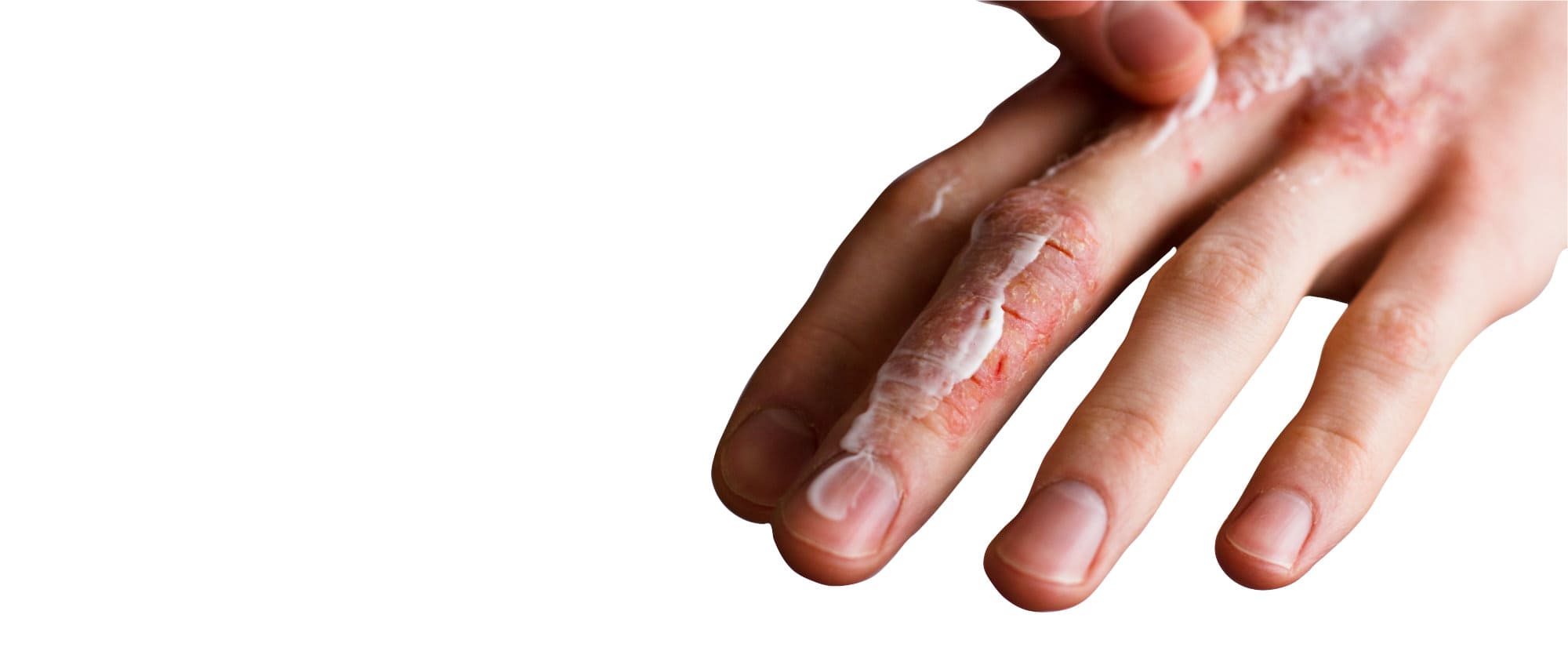 eczema and/or cracked rough dry flakey skin